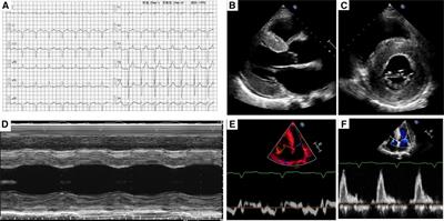 Case Report: A rare transthyretin mutation p.D58Y in a Chinese case of transthyretin amyloid cardiomyopathy